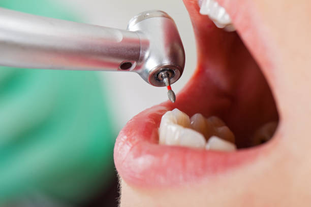 Best Emergency Root Canal Treatment in Mansura, LA